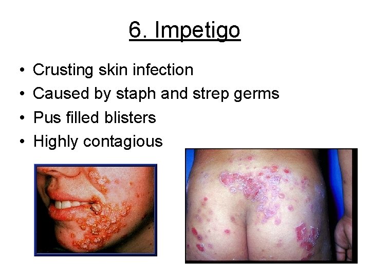 6. Impetigo • • Crusting skin infection Caused by staph and strep germs Pus