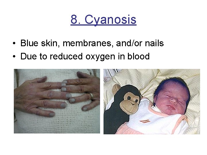 8. Cyanosis • Blue skin, membranes, and/or nails • Due to reduced oxygen in