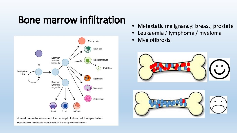 Bone marrow infiltration • Metastatic malignancy: breast, prostate • Leukaemia / lymphoma / myeloma