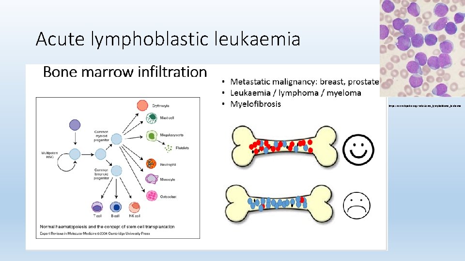 Acute lymphoblastic leukaemia https: //en. wikipedia. org/wiki/Acute_lymphoblastic_leukemia 