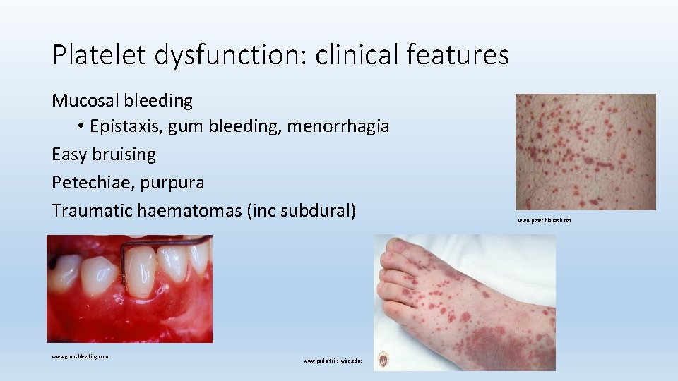 Platelet dysfunction: clinical features Mucosal bleeding • Epistaxis, gum bleeding, menorrhagia Easy bruising Petechiae,