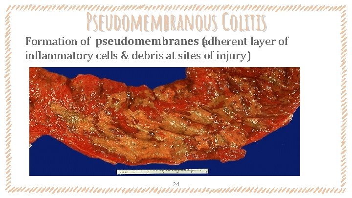Pseudomembranous Colitis Formation of pseudomembranes (adherent layer of inflammatory cells & debris at sites
