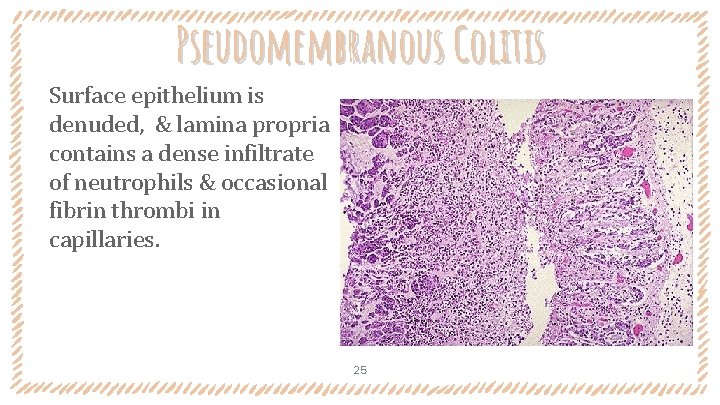 Pseudomembranous Colitis Surface epithelium is denuded, & lamina propria contains a dense infiltrate of