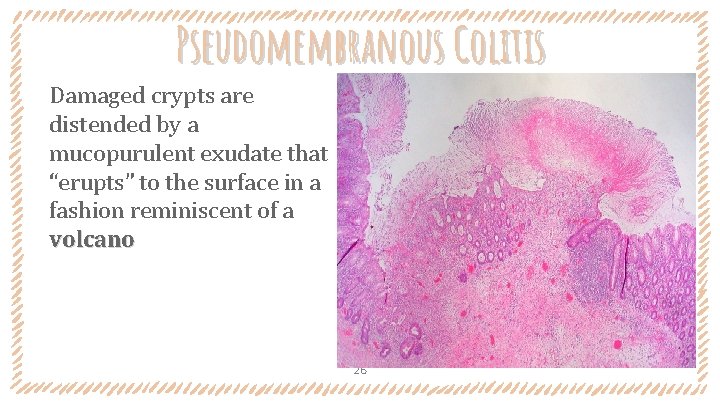 Pseudomembranous Colitis Damaged crypts are distended by a mucopurulent exudate that “erupts” to the