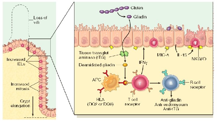 Celiac Disease 7 