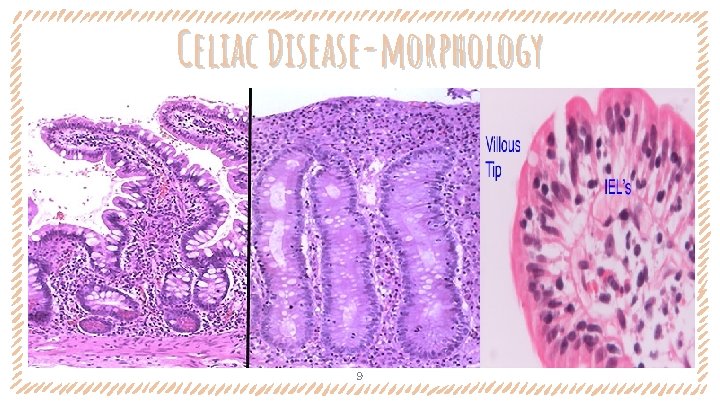 Celiac Disease-morphology 9 