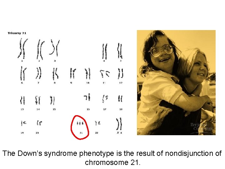 The Down’s syndrome phenotype is the result of nondisjunction of chromosome 21. 