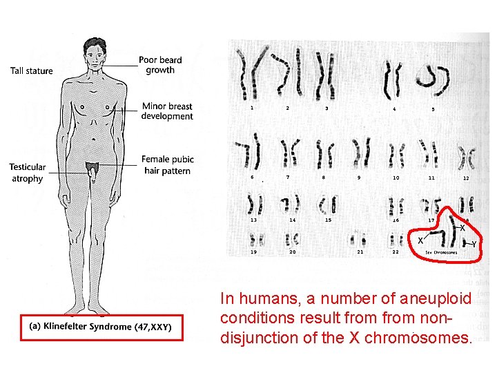 In humans, a number of aneuploid conditions result from nondisjunction of the X chromosomes.