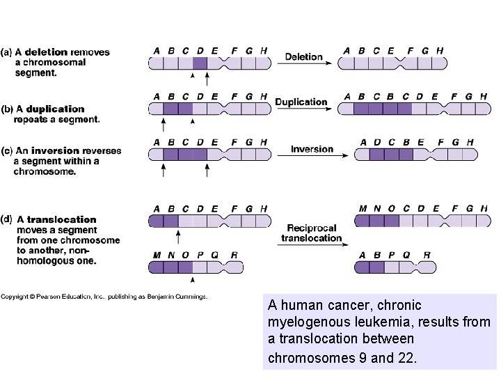 A human cancer, chronic myelogenous leukemia, results from a translocation between chromosomes 9 and