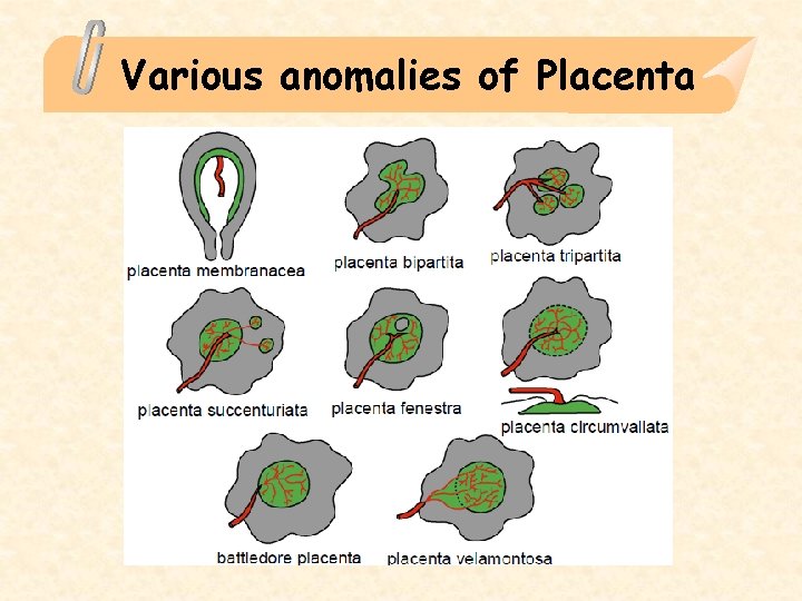 Various anomalies of Placenta 