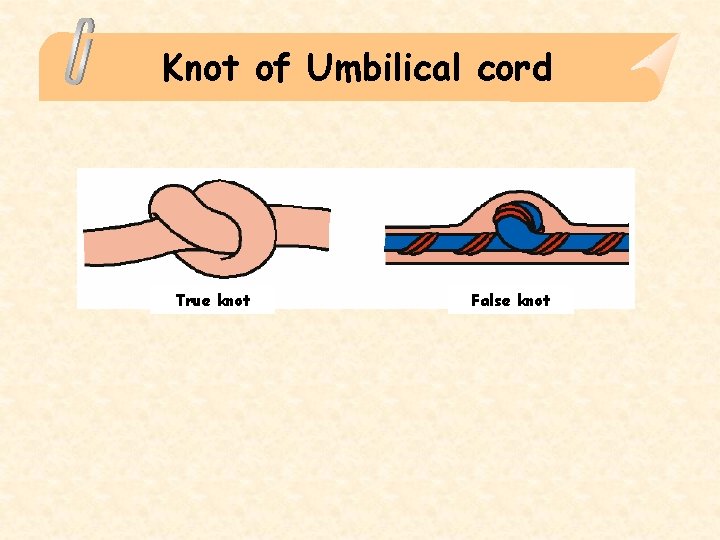 Knot of Umbilical cord True knot False knot 