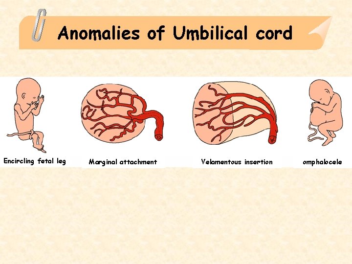 Anomalies of Umbilical cord Encircling fetal leg Marginal attachment Velamentous insertion omphalocele 