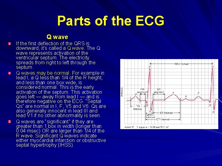 Parts of the ECG Q wave If the first deflection of the QRS is