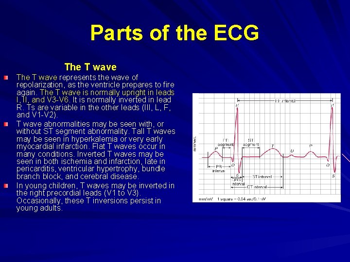 Parts of the ECG The T wave represents the wave of repolarization, as the