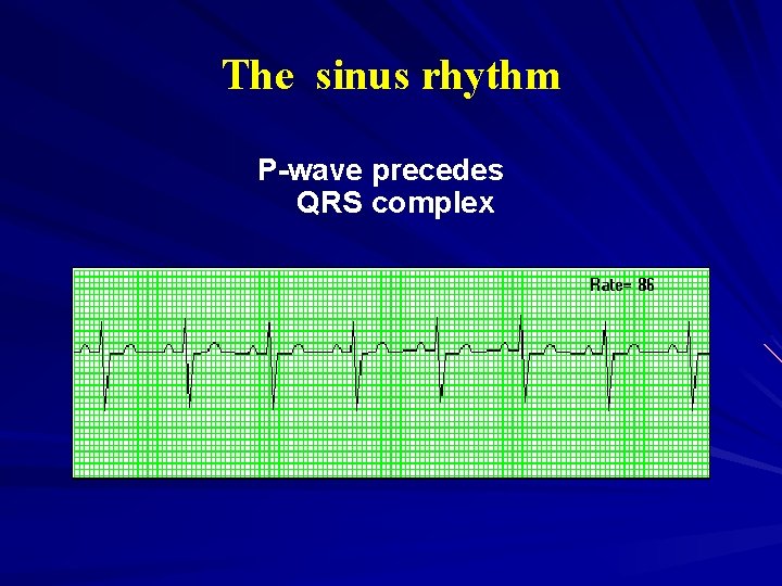 The sinus rhythm P-wave precedes QRS complex 