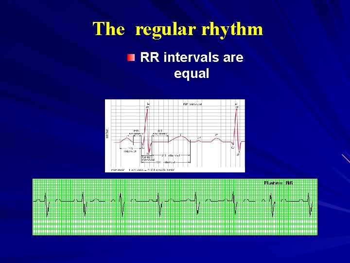 The regular rhythm RR intervals are equal 
