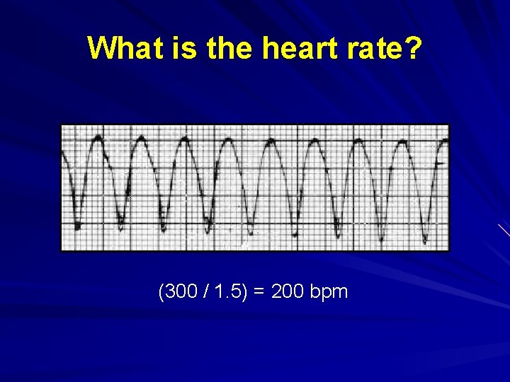 What is the heart rate? (300 / 1. 5) = 200 bpm 