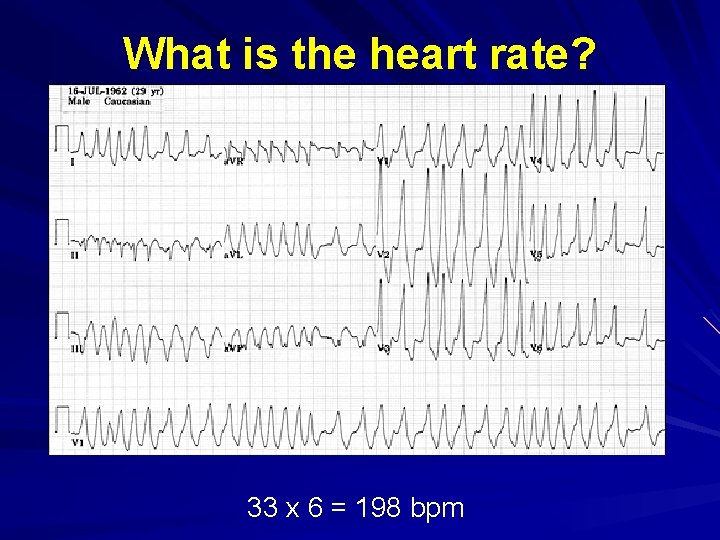 What is the heart rate? 33 x 6 = 198 bpm 