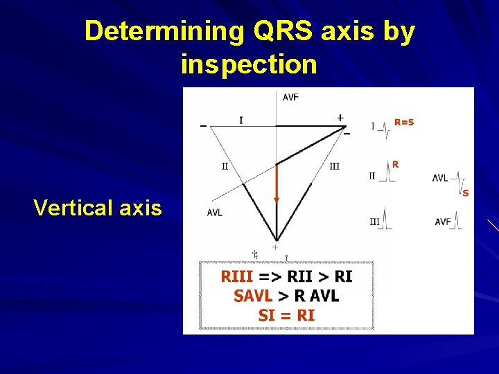 Determining QRS axis by inspection Vertical axis 
