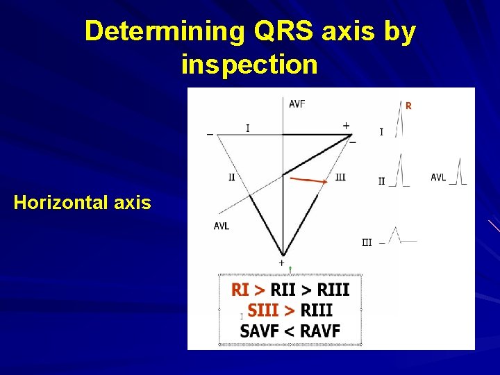 Determining QRS axis by inspection Horizontal axis 