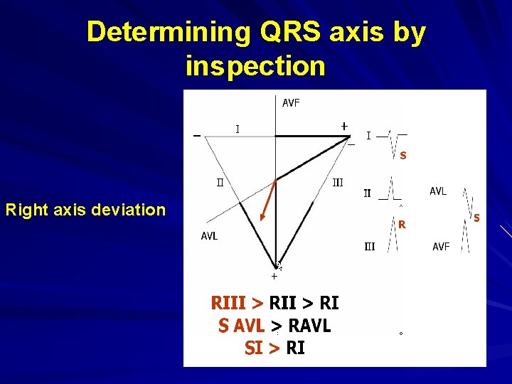 Determining QRS axis by inspection Right axis deviation 