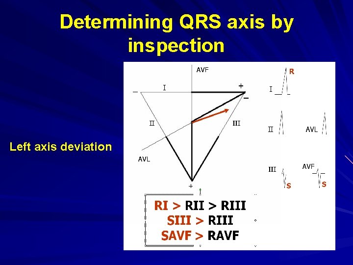Determining QRS axis by inspection Left axis deviation 