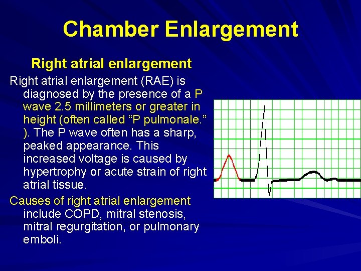Chamber Enlargement Right atrial enlargement (RAE) is diagnosed by the presence of a P