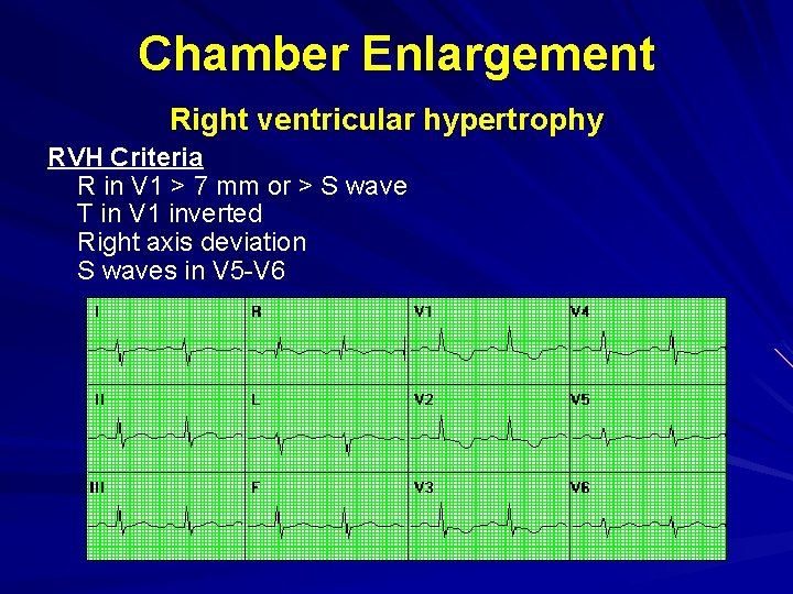 Chamber Enlargement Right ventricular hypertrophy RVH Criteria R in V 1 > 7 mm