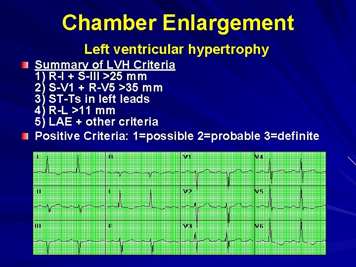 Chamber Enlargement Left ventricular hypertrophy Summary of LVH Criteria 1) R-I + S-III >25