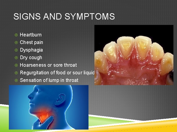 SIGNS AND SYMPTOMS Heartburn Chest pain Dysphagia Dry cough Hoarseness or sore throat Regurgitation