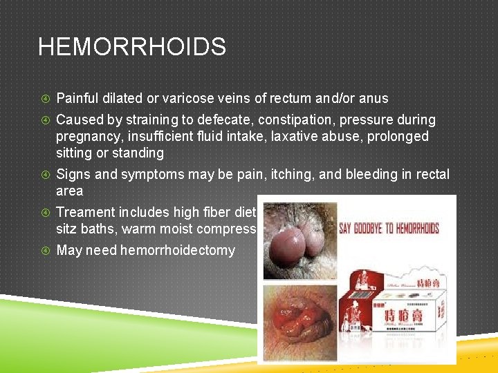 HEMORRHOIDS Painful dilated or varicose veins of rectum and/or anus Caused by straining to