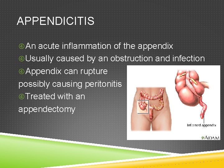 APPENDICITIS An acute inflammation of the appendix Usually caused by an obstruction and infection