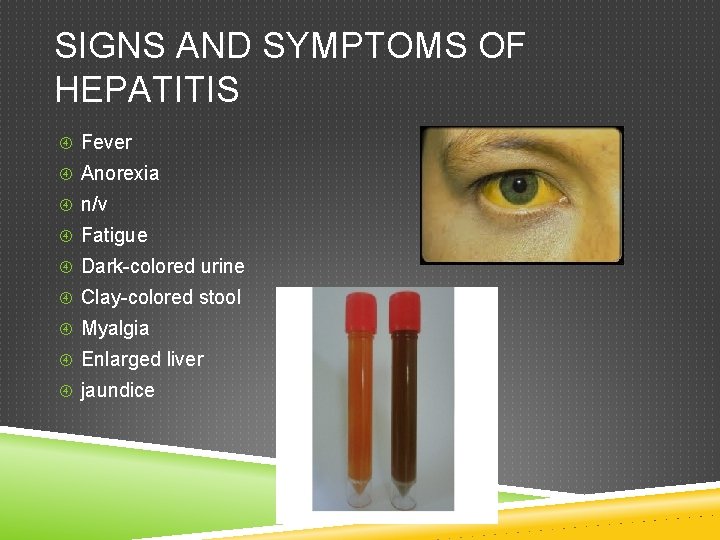 SIGNS AND SYMPTOMS OF HEPATITIS Fever Anorexia n/v Fatigue Dark-colored urine Clay-colored stool Myalgia