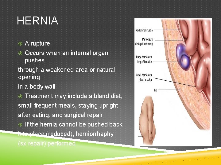 HERNIA A rupture Occurs when an internal organ pushes through a weakened area or