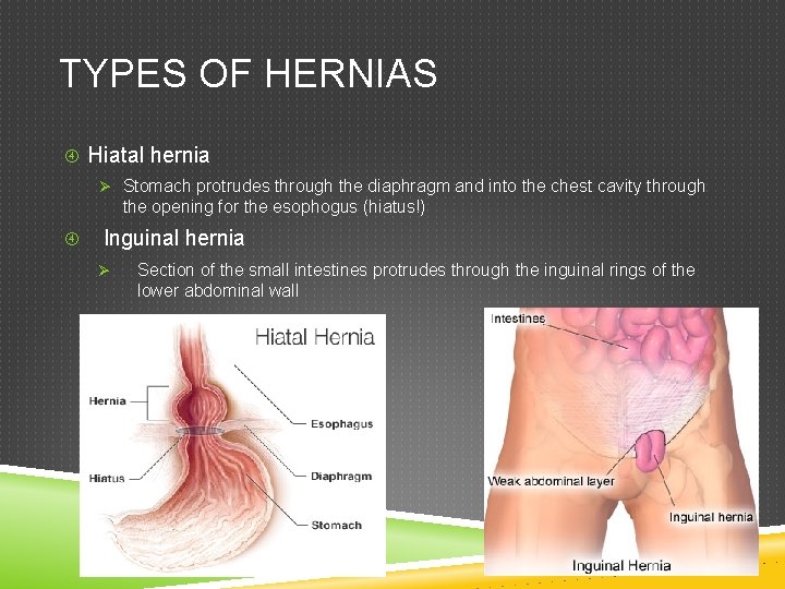 TYPES OF HERNIAS Hiatal hernia Ø Stomach protrudes through the diaphragm and into the