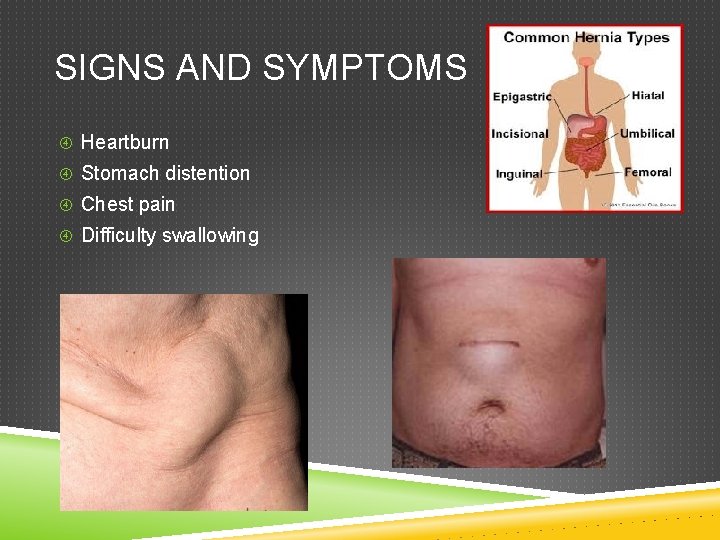 SIGNS AND SYMPTOMS Heartburn Stomach distention Chest pain Difficulty swallowing 