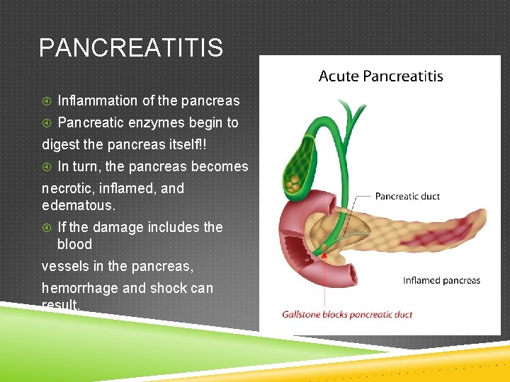 PANCREATITIS Inflammation of the pancreas Pancreatic enzymes begin to digest the pancreas itself!! In