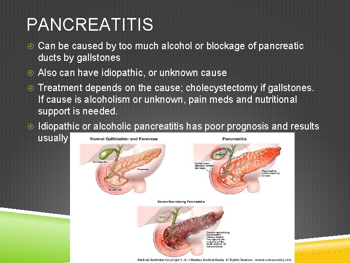 PANCREATITIS Can be caused by too much alcohol or blockage of pancreatic ducts by