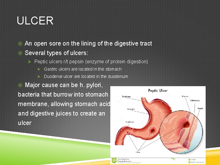ULCER An open sore on the lining of the digestive tract Several types of