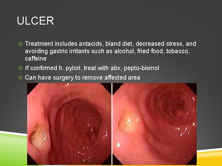 ULCER Treatment includes antacids, bland diet, decreased stress, and avoiding gastric irritants such as