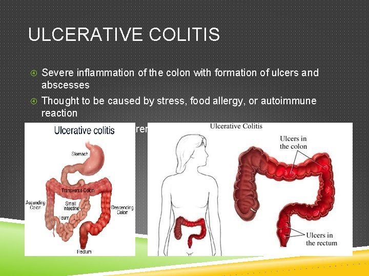 ULCERATIVE COLITIS Severe inflammation of the colon with formation of ulcers and abscesses Thought