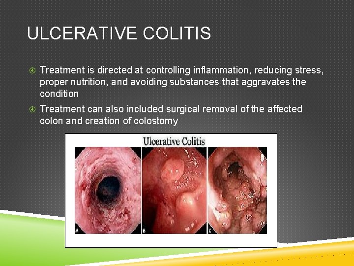ULCERATIVE COLITIS Treatment is directed at controlling inflammation, reducing stress, proper nutrition, and avoiding