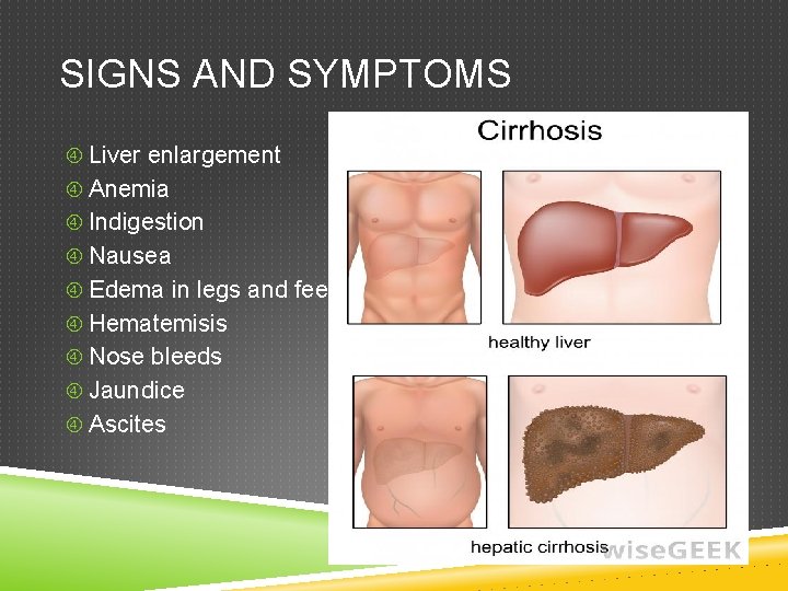 SIGNS AND SYMPTOMS Liver enlargement Anemia Indigestion Nausea Edema in legs and feet Hematemisis