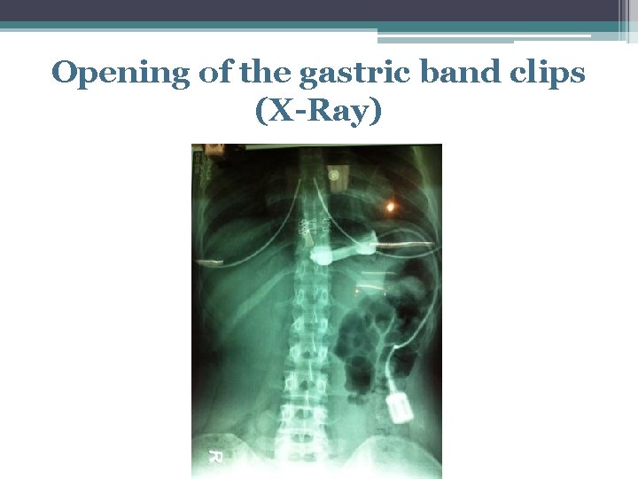 Opening of the gastric band clips (X-Ray) 