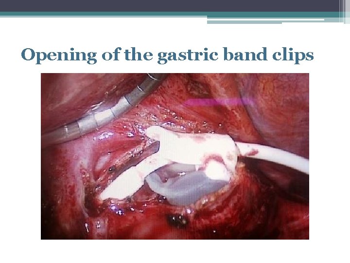 Opening of the gastric band clips 
