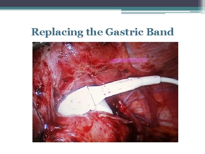 Replacing the Gastric Band 