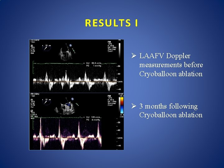 RESULTS Ι Ø LAAFV Doppler measurements before Cryoballoon ablation Ø 3 months following Cryoballoon