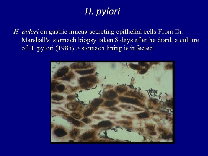 H. pylori on gastric mucus-secreting epithelial cells From Dr. Marshall's stomach biopsy taken 8