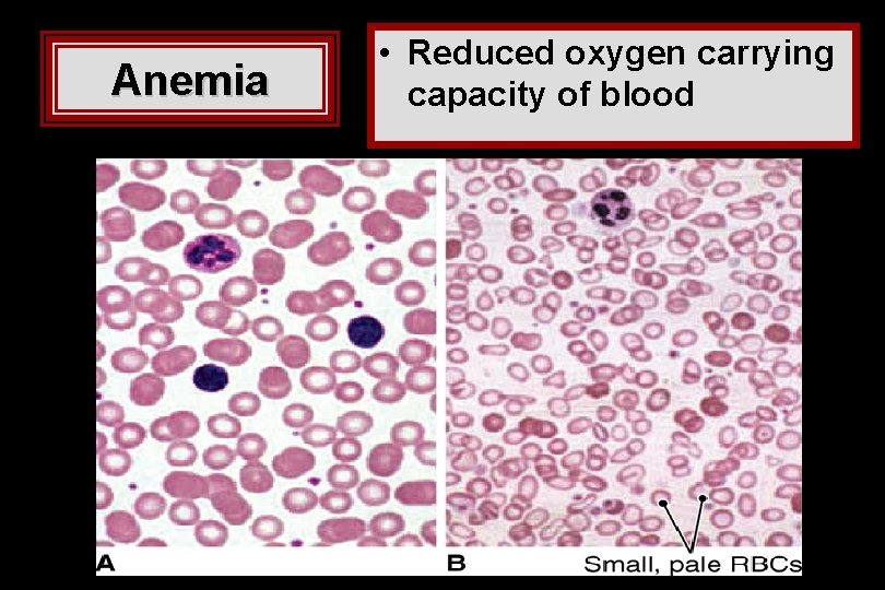 Anemia • Reduced oxygen carrying capacity of blood Anemia • Reduced oxygen carrying capacity of blood