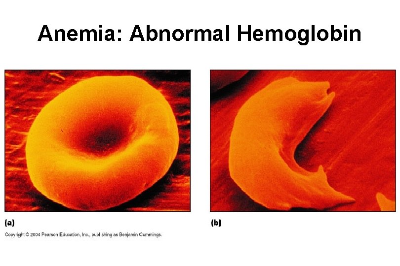 Anemia: Abnormal Hemoglobin Anemia: Abnormal Hemoglobin